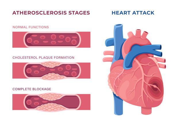 Diagram showing heart attack as blocked artery vs cardiac arrest as electrical failure"
